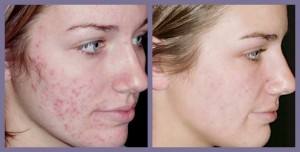 Acne scars DIMINISHED.