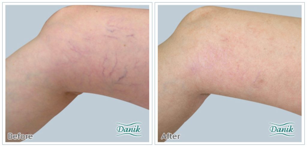 Vein Removal Before and After Photo