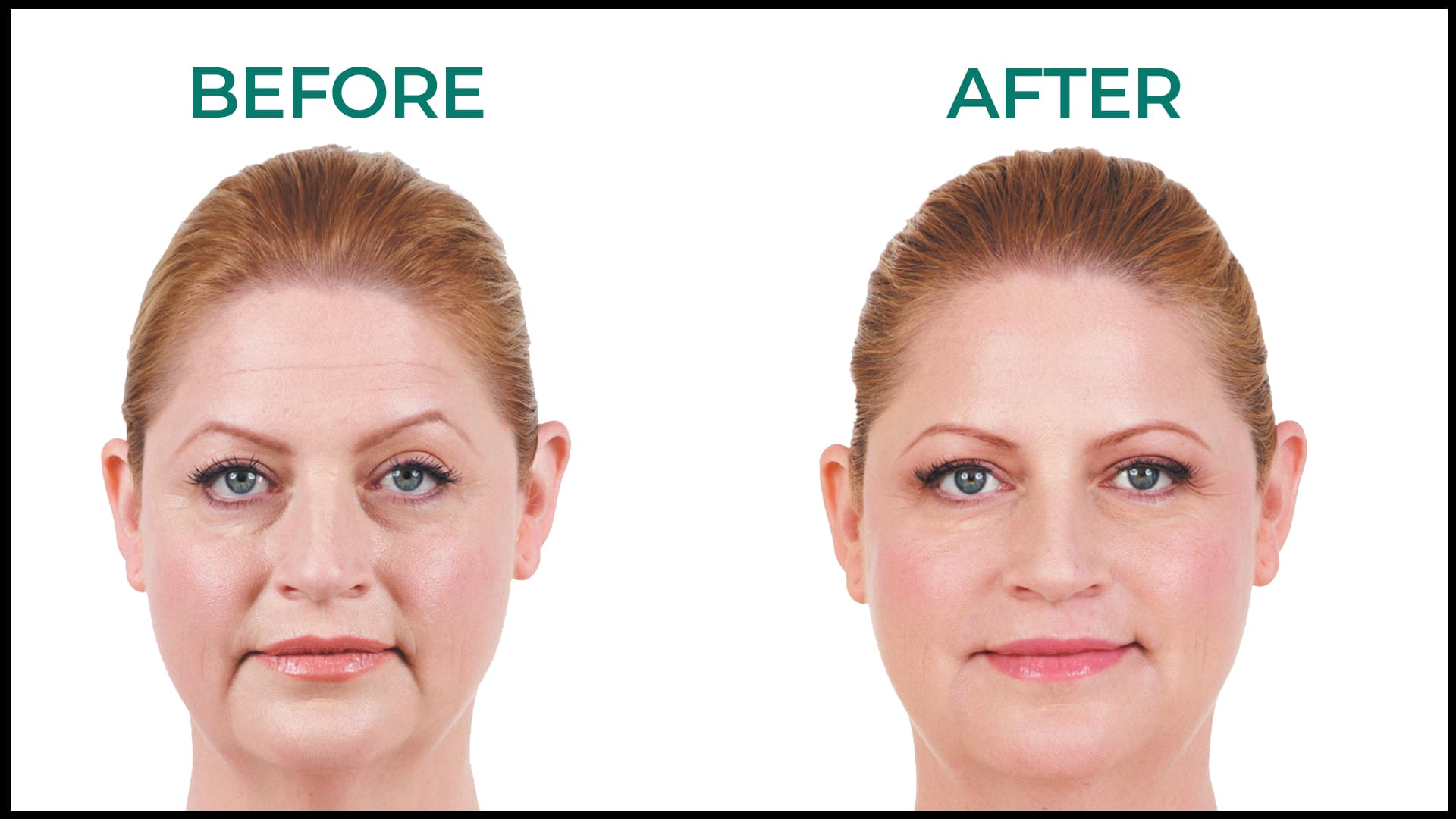 juvederm