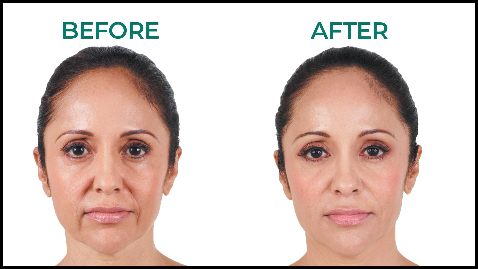 juvederm