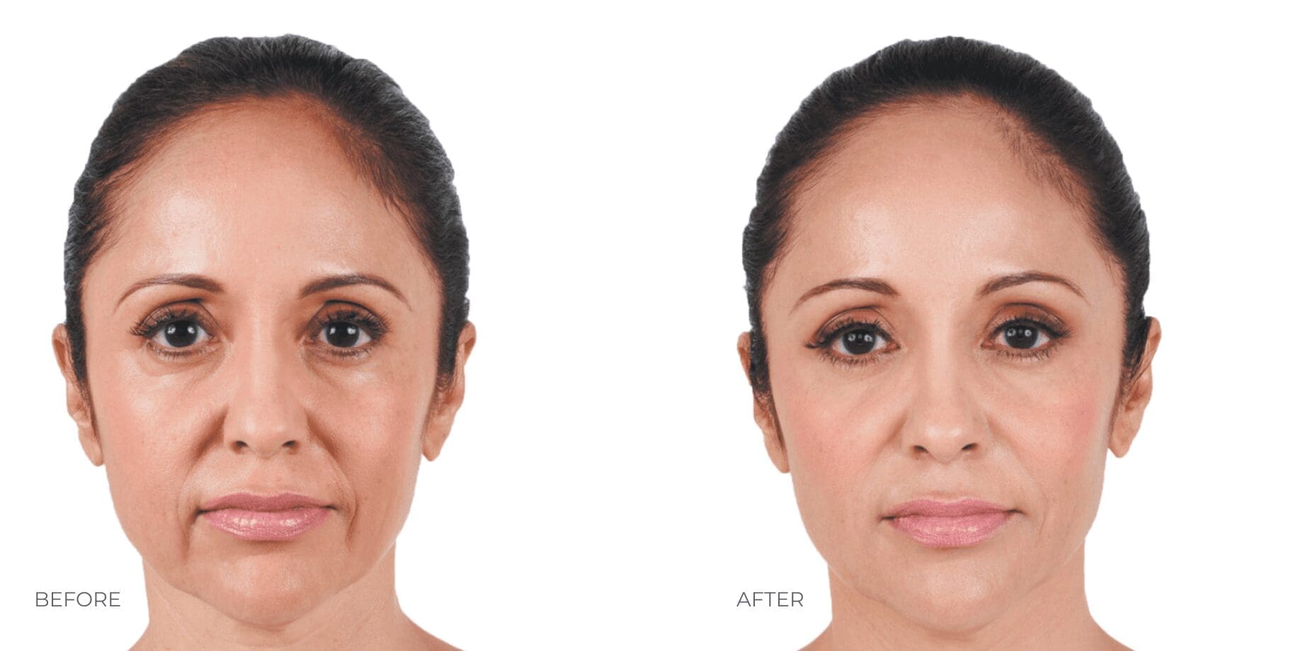Juvederm