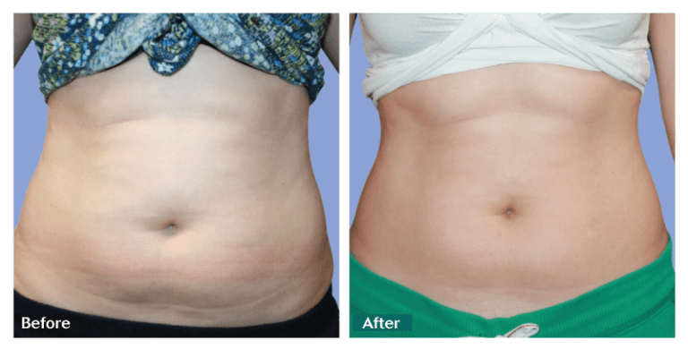 what is body sculpting