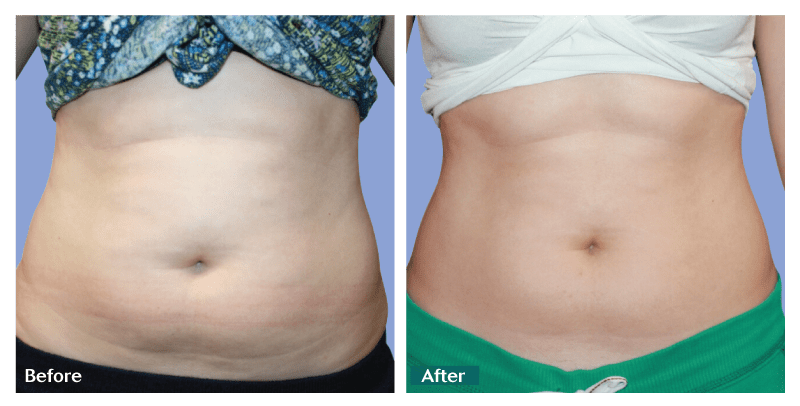 what is body sculpting