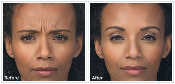 botox1