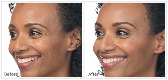 Before And After Side Image Of Facial Treatment For Brows And Crows Feet On A Woman Face