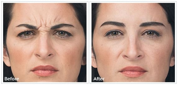 Before And After Image Of Facial Treatment For Brows And Crows Feet On A Woman Face