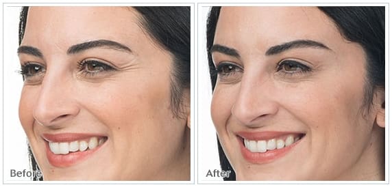 Before And After Front Image Of Facial Treatment For Brows And Crows Feet On A Woman Face