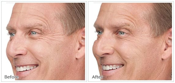 Before And After Side Image Of Facial Treatment For Brows And Crows Feet On A Man Face