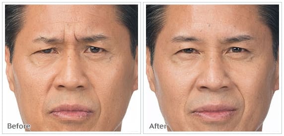 botox2