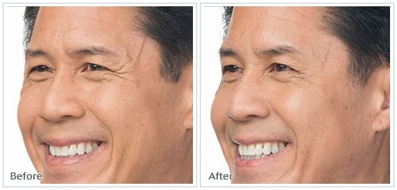 botox3