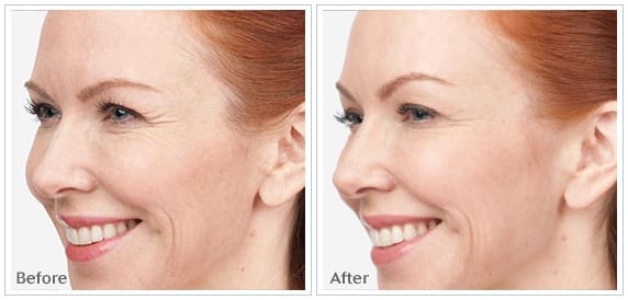 botox6