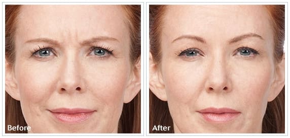 botox7