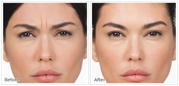 botox8