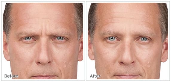 botox9