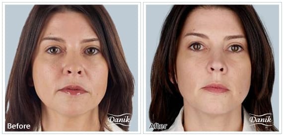 danik-med-spa-prp-face-vampire-facelift-2-1-o5sr26h6vou1m1u82k7rwhpnm6bs696f9b4m5gu3lg