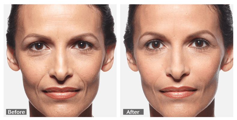 Juvederm