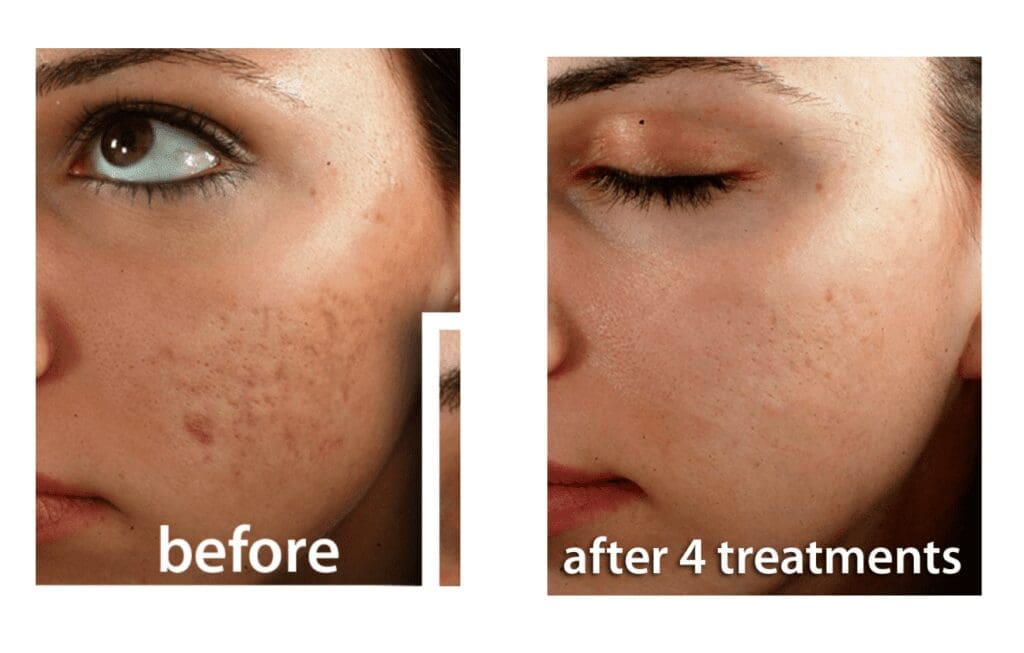 Showcase Of Woman's Face Before And After Facial Treatment For Acne Showing visible Improvement Reducing Acne Scars