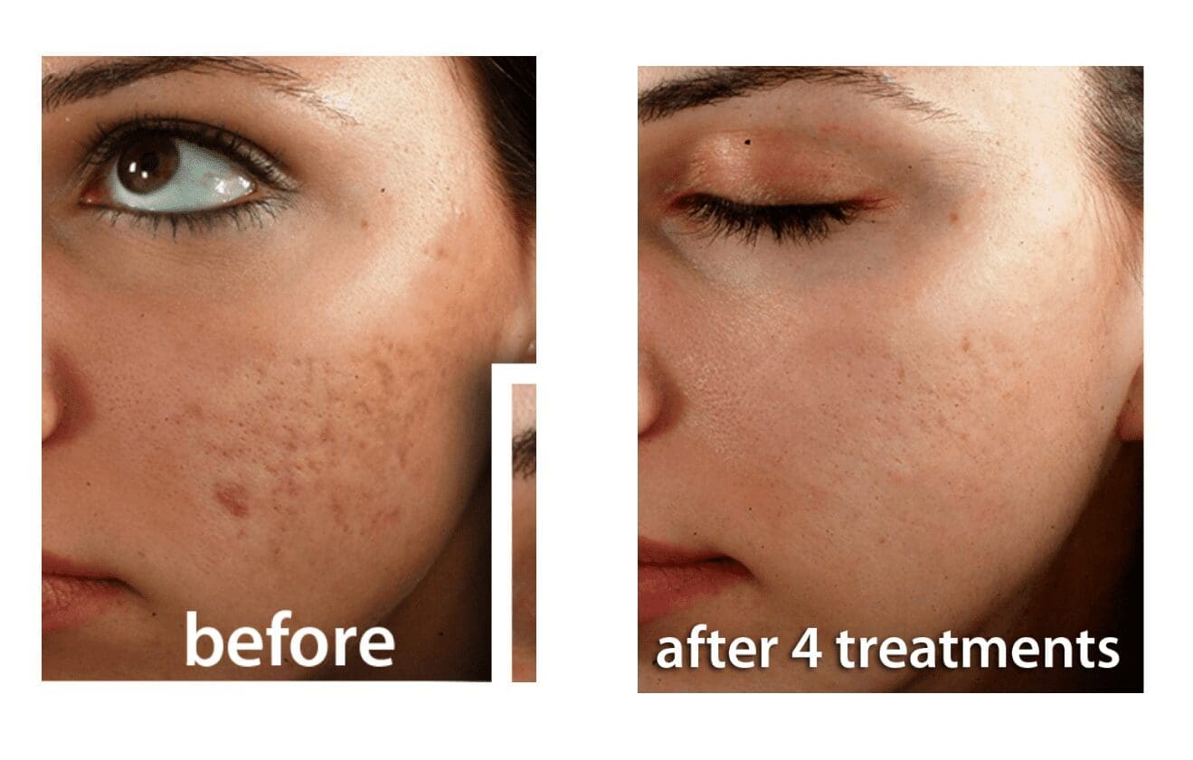 Showcase Of Woman's Face Before And After Facial Treatment For Acne Showing visible Improvement Reducing Acne Scars