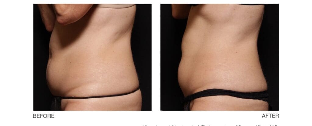 Body Contour Treatment Before And After Results On Woman Abs With Visible Results For Body Sculpting