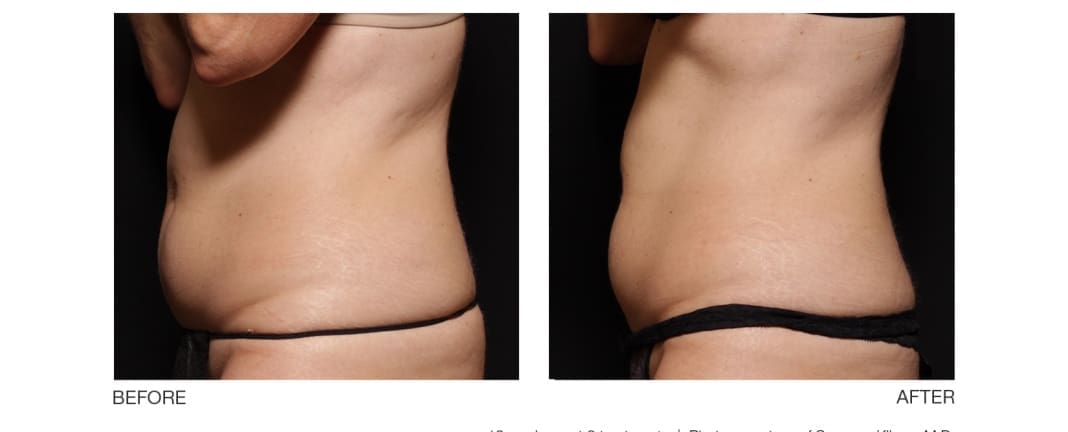 Body Contour Treatment Before And After Results On Woman Abs With Visible Results For Body Sculpting