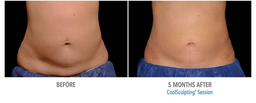 CoolSculpting Before And After Body Contour Results Showing Woman Contoured Silhouette Of Abs After 5 Months Of Treatment
