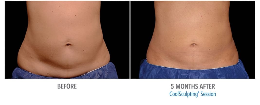 CoolSculpting Before And After Body Contour Results Showing Woman Contoured Silhouette Of Abs After 5 Months Of Treatment