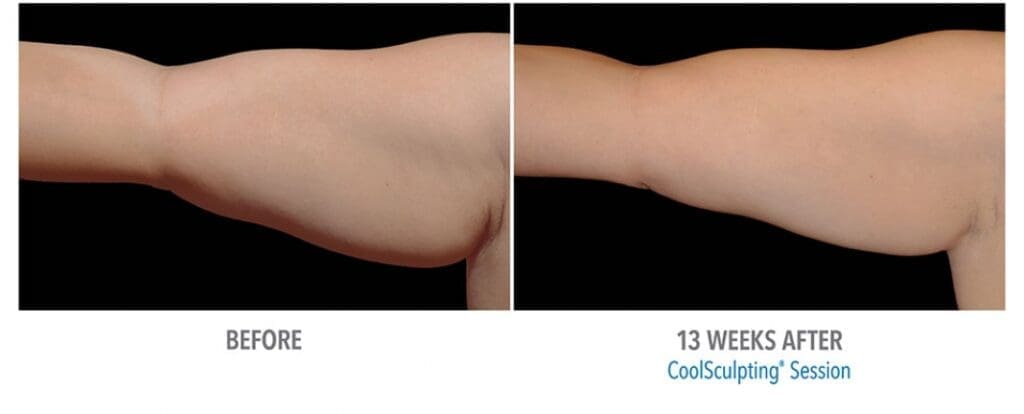 CoolSculpting Before And After Body Contour Results Showing Sculpted Arm After 13 Weeks Of Treatment