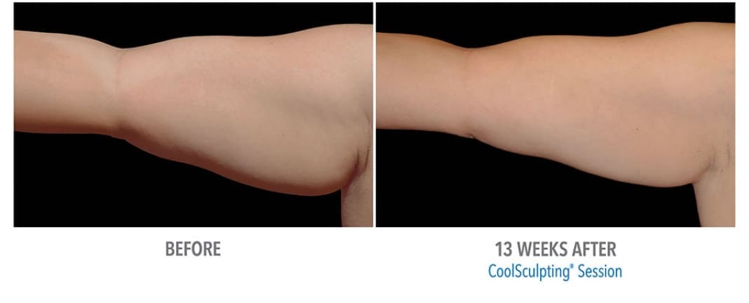CoolSculpting Before And After Body Contour Results Showing Sculpted Arm After 13 Weeks Of Treatment