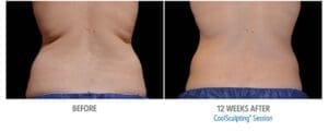 CoolSculpting Before And After Body Sculpting Results Showing Contoured Silhouette Of Torso After 12 Weeks Of Treatment