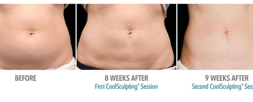 CoolSculpting Before And After Body Sculpting Results Showing Contoured Silhouette Of Abs After 8 and 9 Weeks Of Treatment
