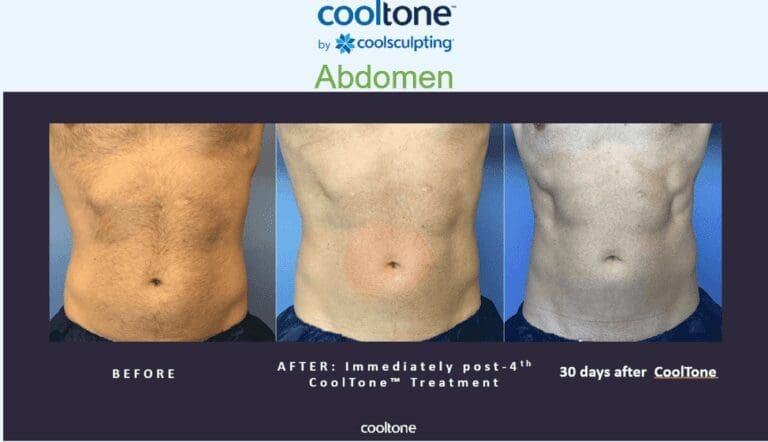 Coolsculpting cost