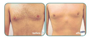 Best Laser Hair Removal Treatment Before And After Image On Men Chest Showing Visible Results