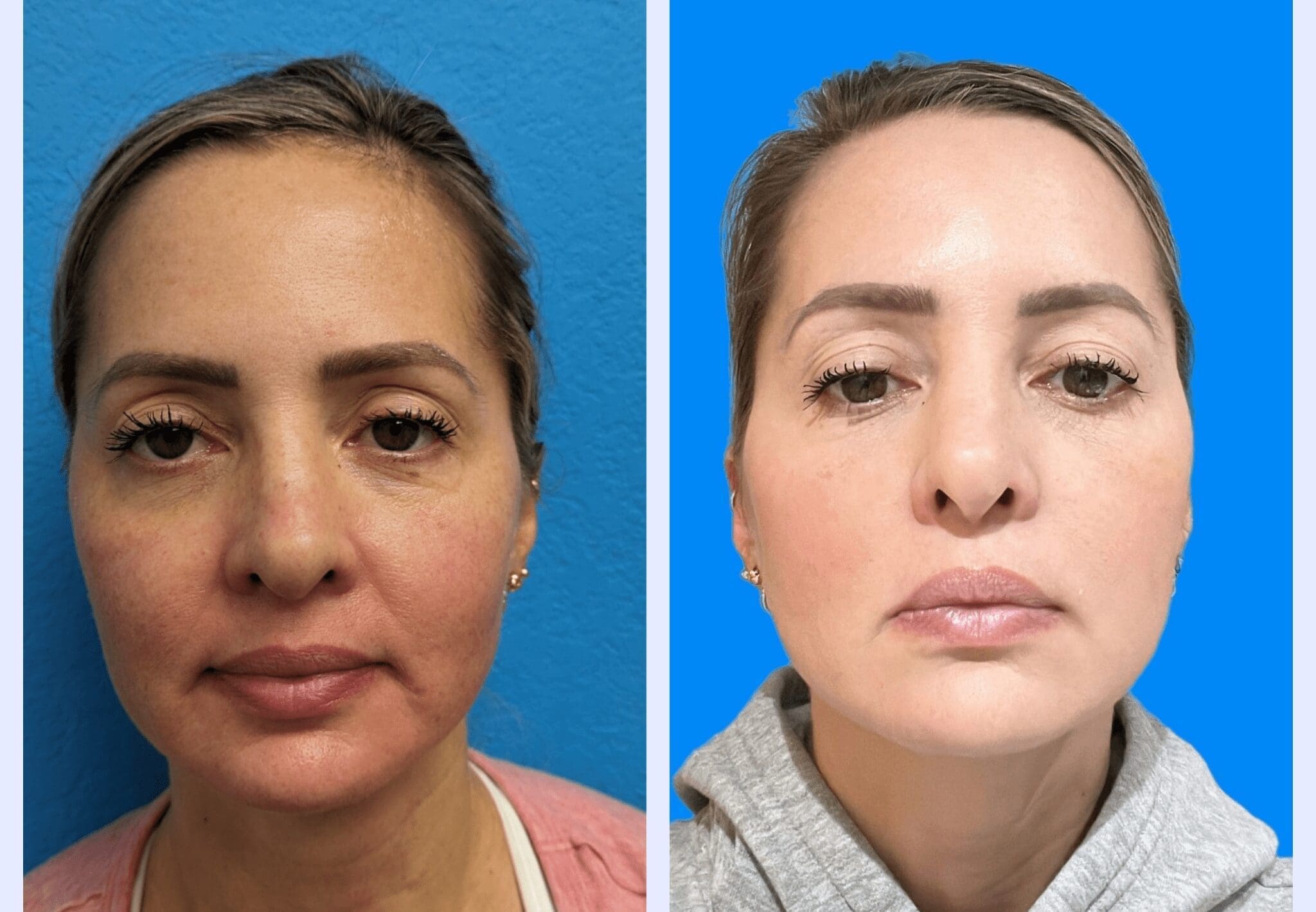 PDO Threads Facelift Facial Treatment Before And After Results On Woman Face With Visible Improvements