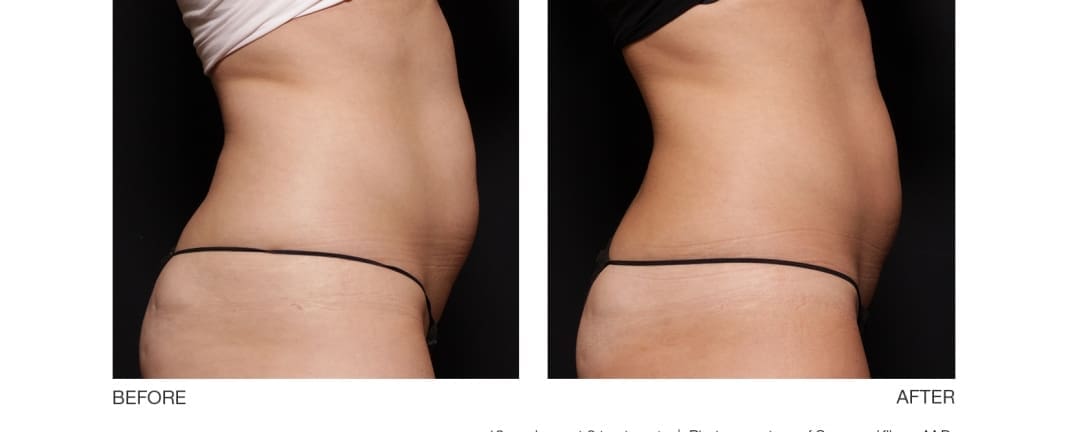 Ultrashape Body Contour Treatment Before And After Results On Woman Abs With Visible Results For Body Sculpting