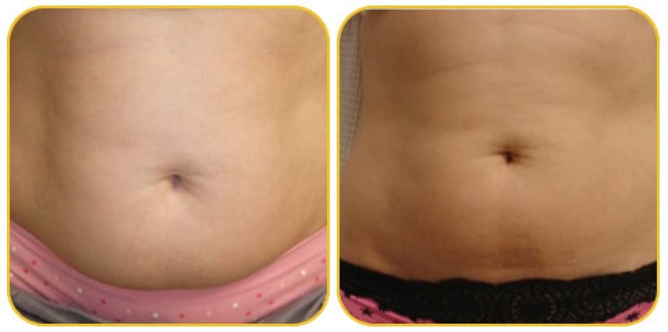 Venus Bliss Treatment For Woman Abs Showing Before And After Visible Improvements For Body Contour