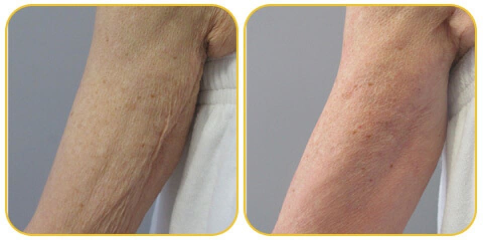 Venus Bliss Treatment For Woman Arms Showing Before And After Visible Improvements For Body Contour