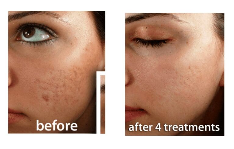 acne (1)