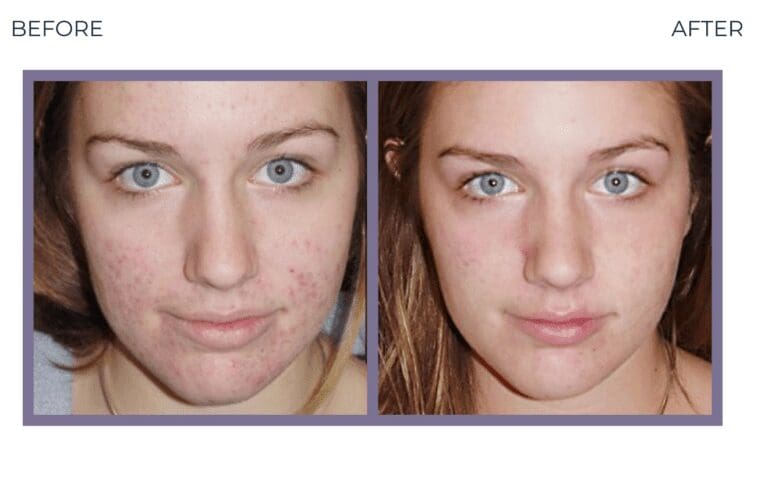 acne (2)