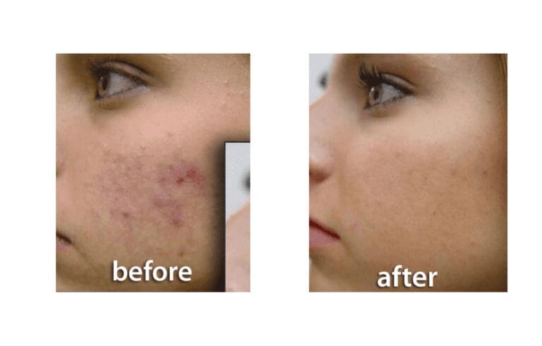 acne (3)