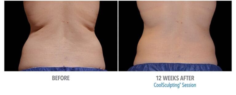 Coolsculpting cost
