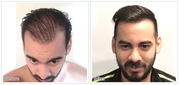 danik-med-spa-surgery-hair-transplantation2