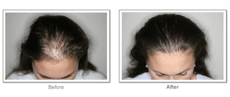 hairlosssteam (3)