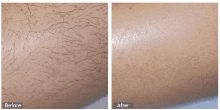 hairremoval (1)