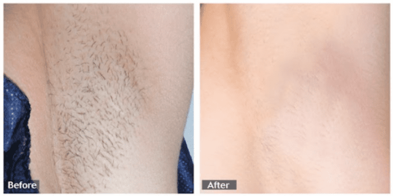 hairremoval (3)