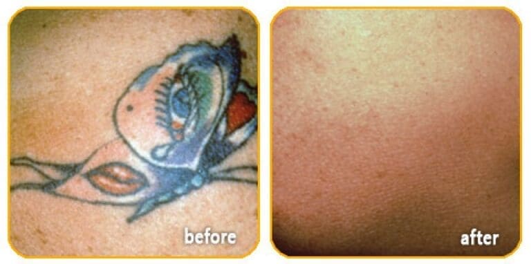 slider-tattoo1-o5srf3rfku7ank0kr1xbe1h8zb0nv7iromjm1fip4c