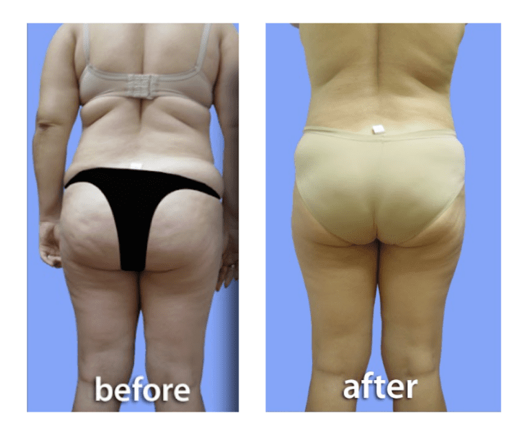 weightloss (2)