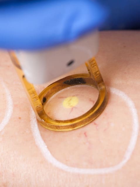 Close-up of sclerotherapy treatment targeting spider veins at Danik MedSpa.