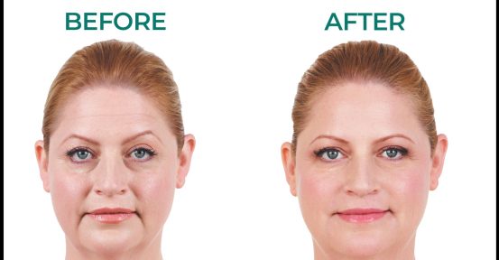 1-JUVEDERM-BEFORE-AFTER-BLK