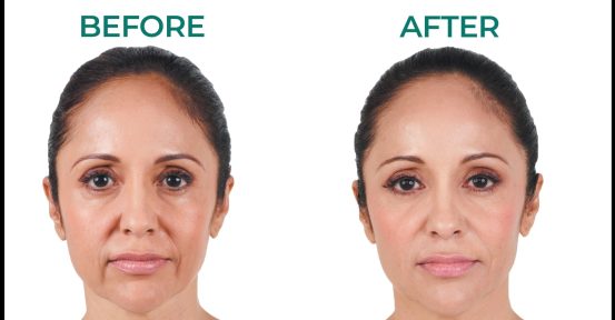 2-JUVEDERM-BEFORE-AFTER-BLK